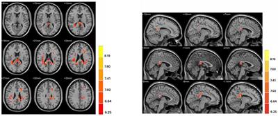 Abnormal Fractional Amplitude of Low-Frequency Fluctuation as a Potential Imaging Biomarker for First-Episode Major Depressive Disorder: A Resting-State fMRI Study and Support Vector Machine Analysis